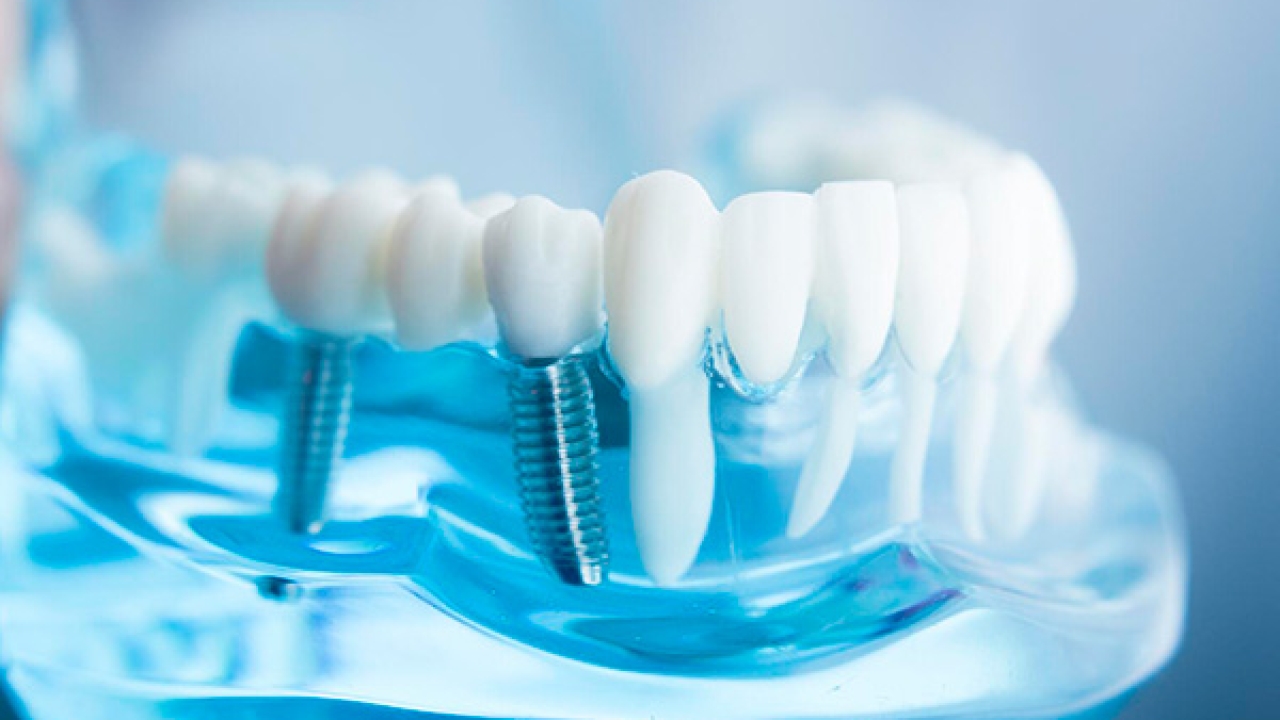 Restore Your Smile with a Single Tooth Implant at Aesthet Clinic