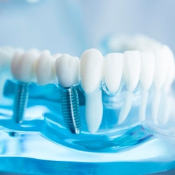 Restore Your Smile with a Single Tooth Implant at Aesthet Clinic