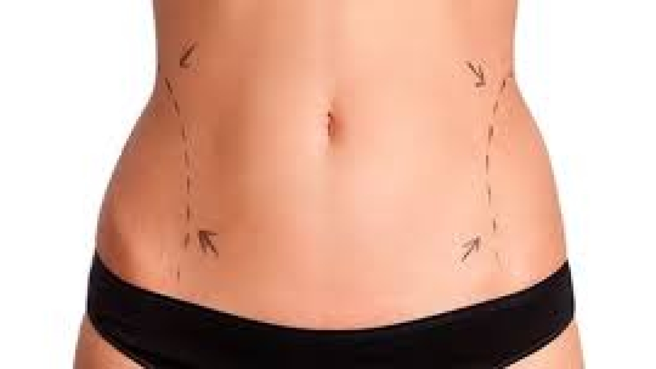 Liposuction Treatment Benefit