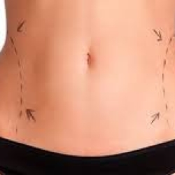 Liposuction Treatment Benefit