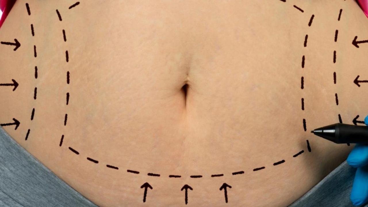 Does Fat Return After Liposuction?