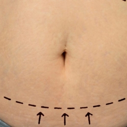 Does Fat Return After Liposuction?