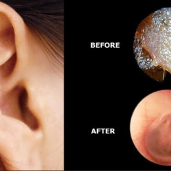 When Do You Need Professional Ear Wax Removal?