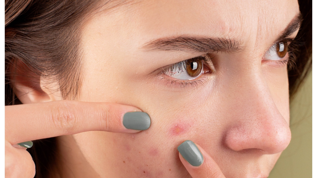 Acne and Abscess in Tweens; Causes, Symptoms and Prevention