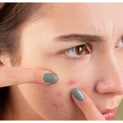 Acne and Abscess in Tweens; Causes, Symptoms and Prevention