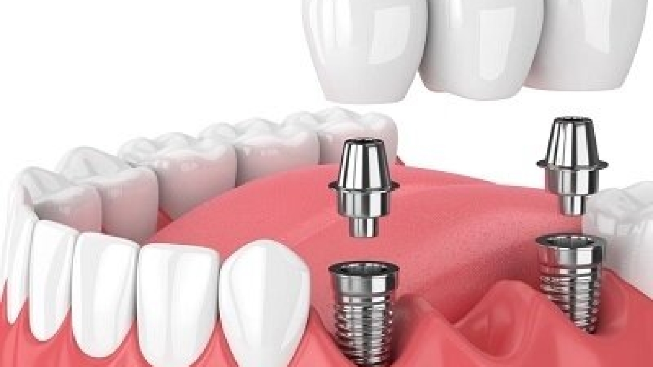 Dental Implants and the Psychological Impact of Tooth Loss