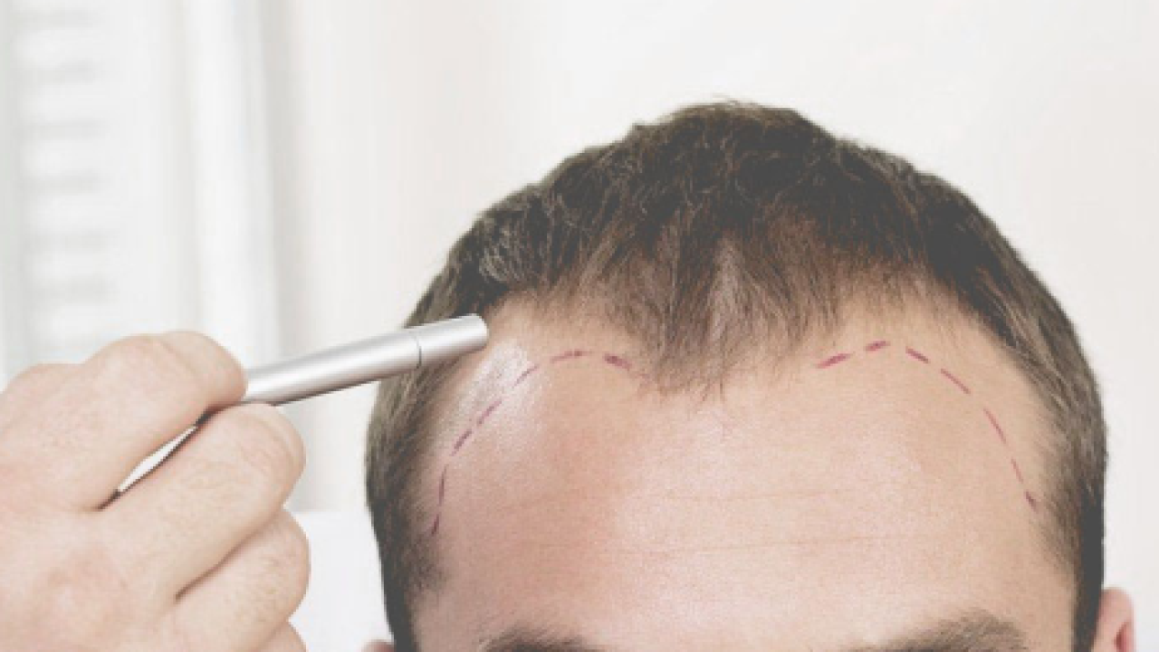 Common Myths About Hair Transplant Debunked