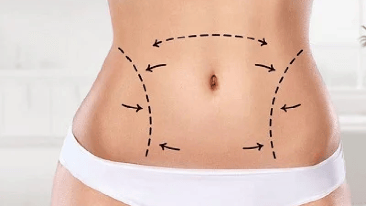 Liposuction Innovations: What's New in Body Contouring Technology