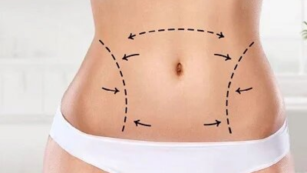 Liposuction for Post-Pregnancy Body Transformation