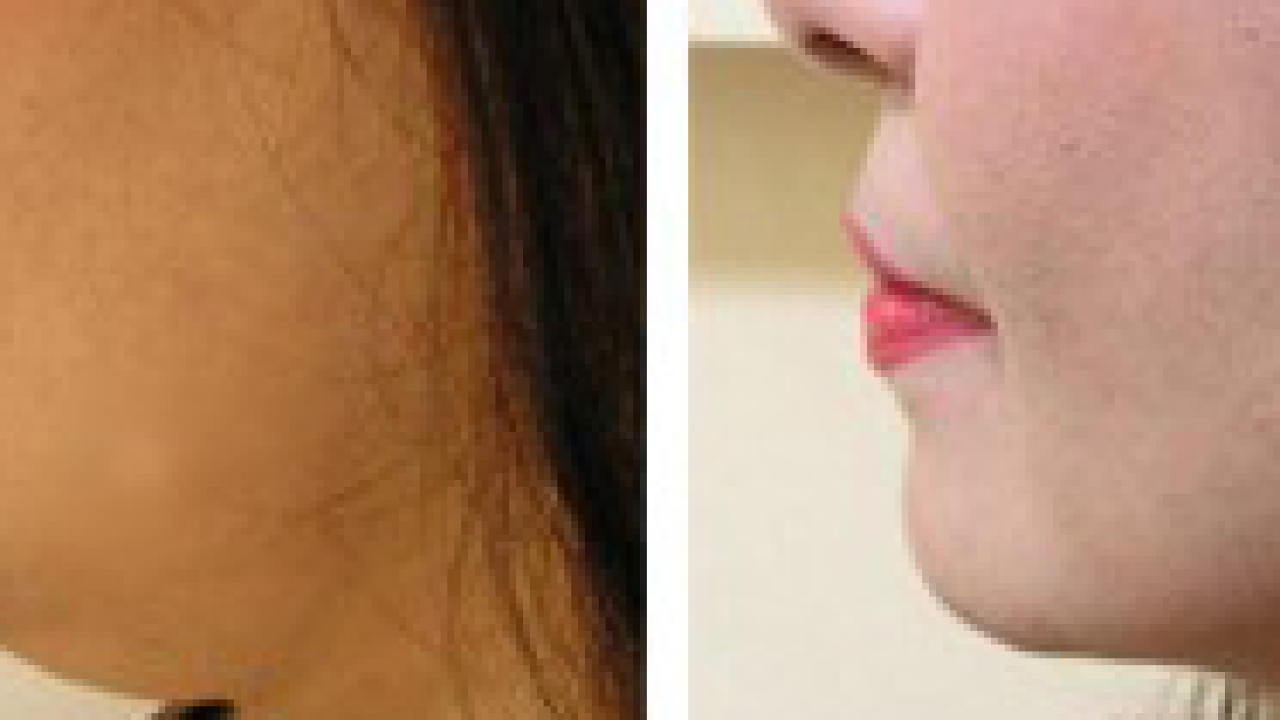 Chin Augmentation vs. Chin Implants: Which is Right for You?