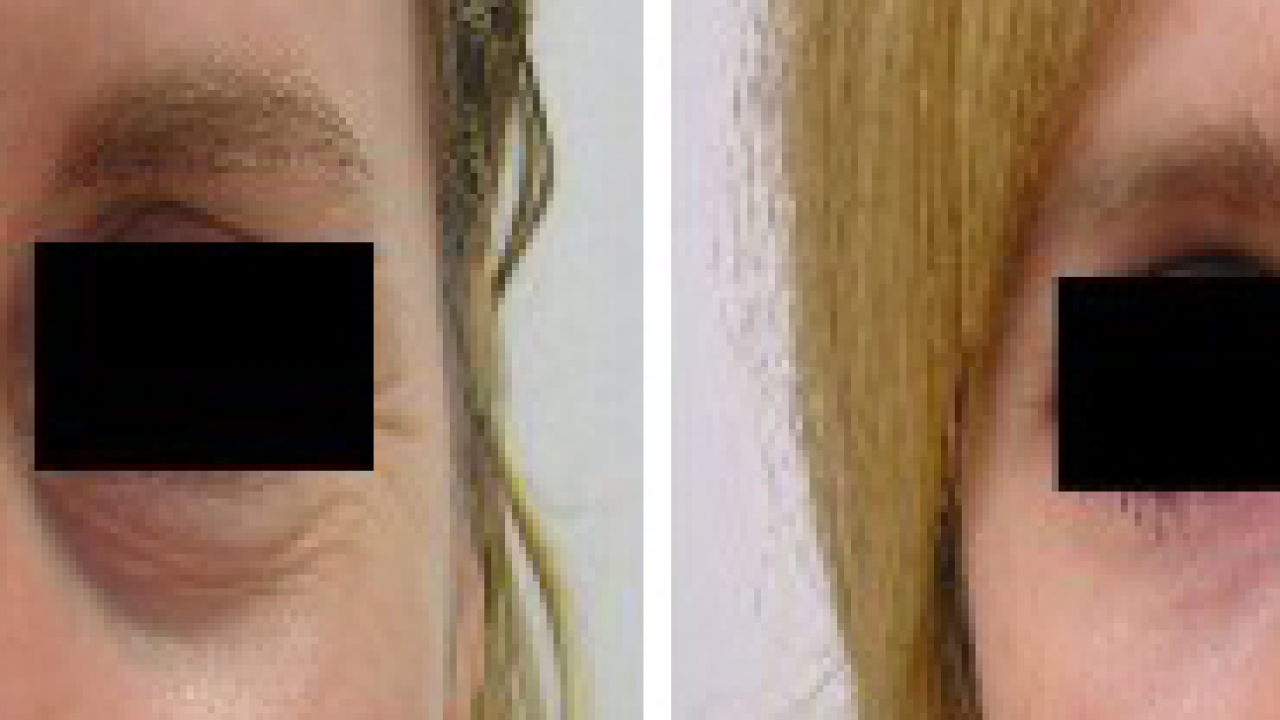 The Psychological Effects of Eyelid Surgery