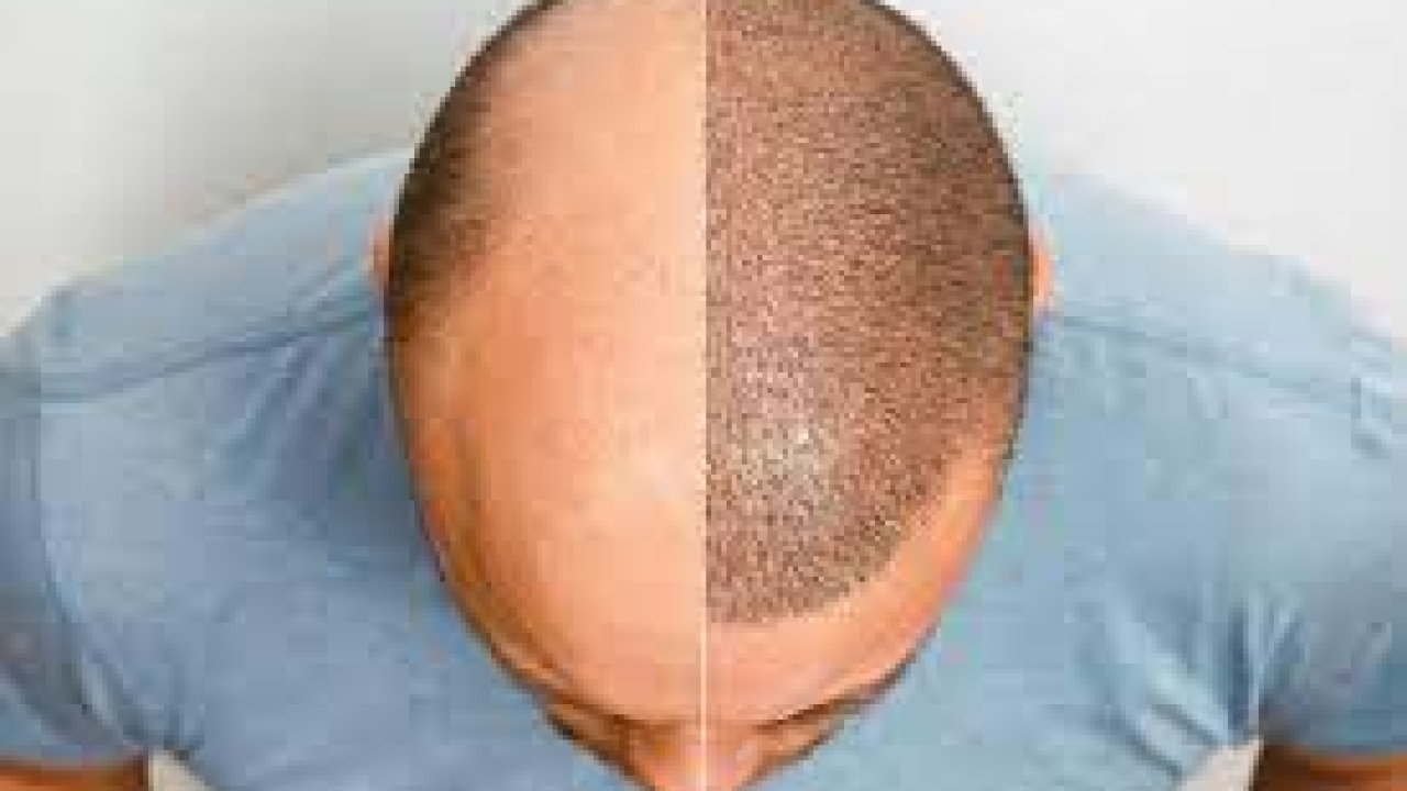 Hair Transplants: Choosing the Right Surgeon