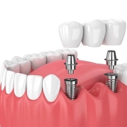 Dental Implants and the Psychological Impact of Tooth Loss