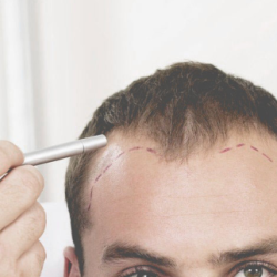 Common Myths About Hair Transplant Debunked