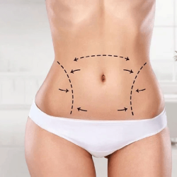 Liposuction Innovations: What's New in Body Contouring Technology