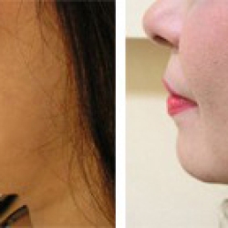 Chin Augmentation vs. Chin Implants: Which is Right for You?