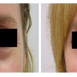 The Psychological Effects of Eyelid Surgery