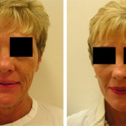 Facelift Clinics 101: Everything You Need to Know Before Your Procedure