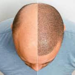 Hair Transplantation in the LGBTQ+ Community